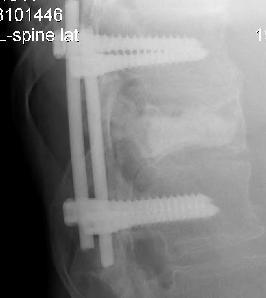 Vertebral Met Posterior Stabilisation + PMMA